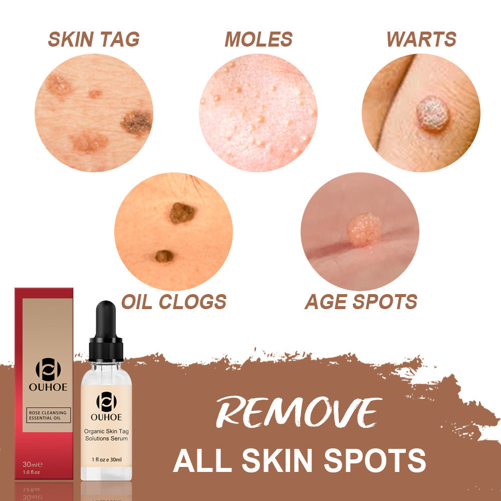 Mole Skin care lotion Repair Mole Black Spot Mole Mole Elimination Rose Essential Oil