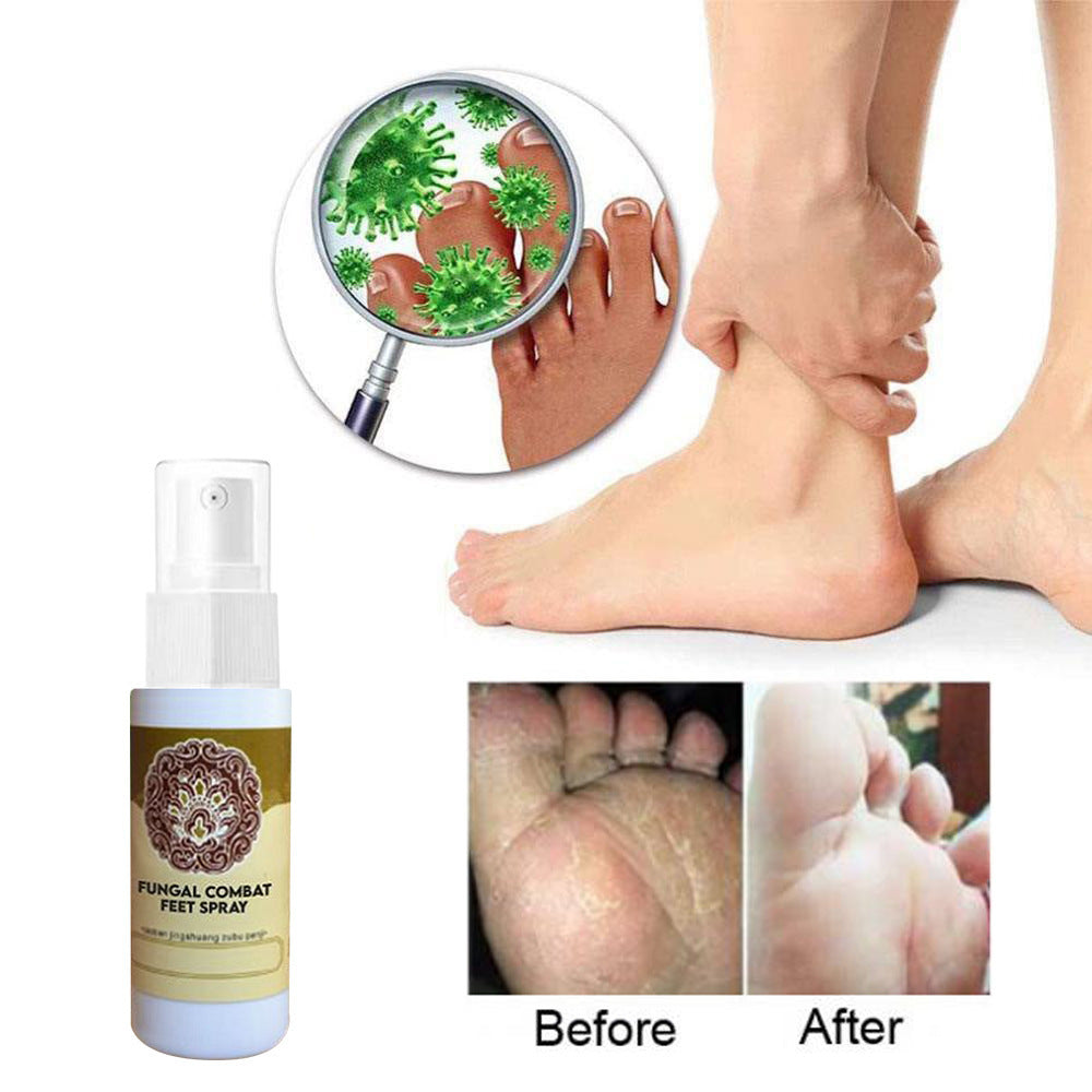 Herbal Antipruritic Athlete's Foot Spray